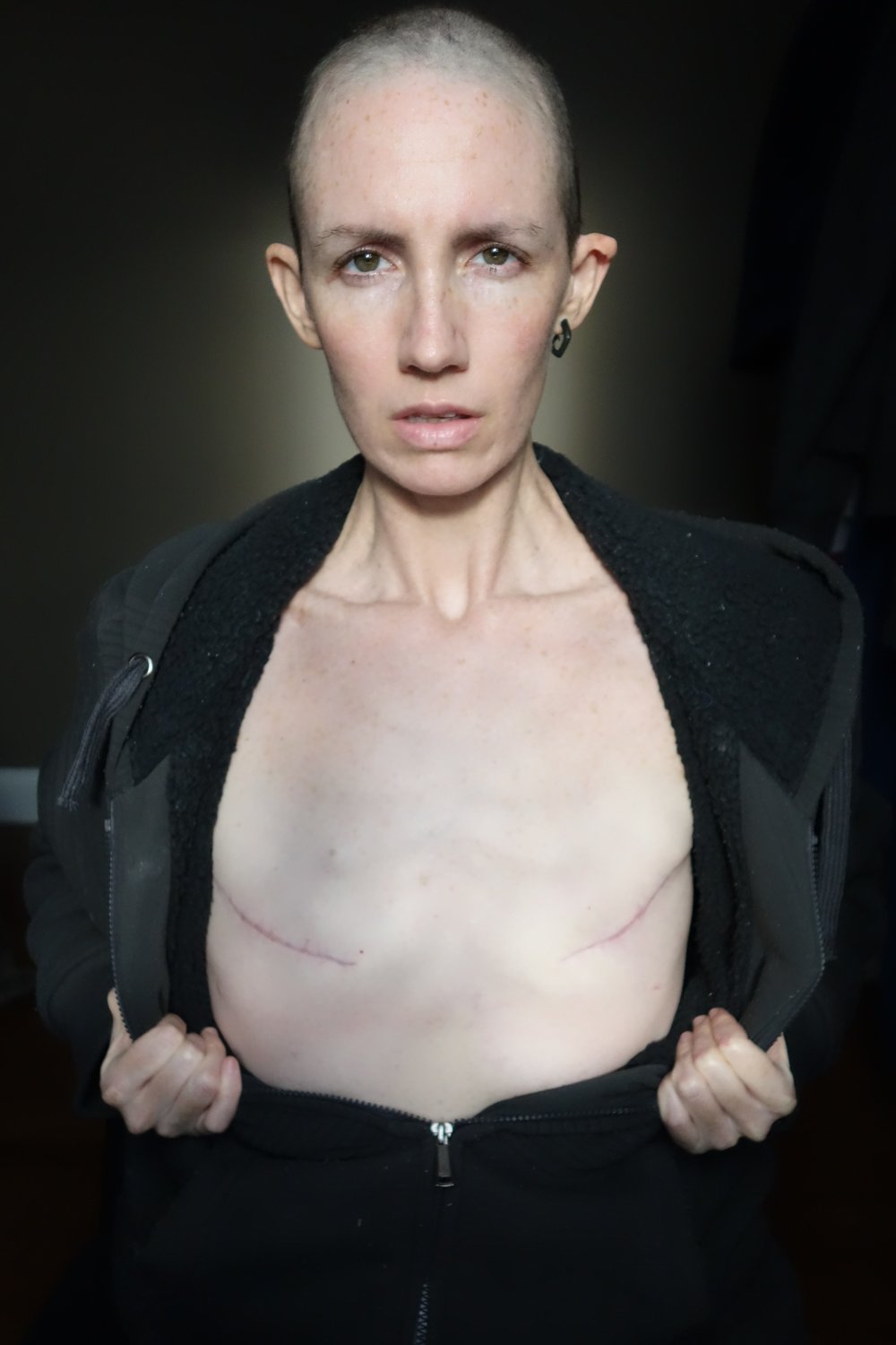 грудь после рак груди у женщин фото 24