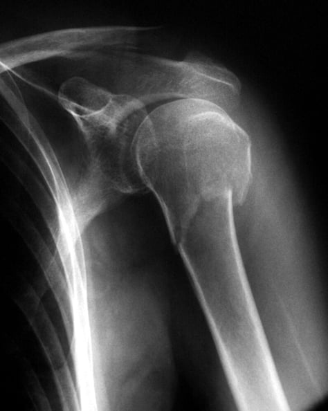 Humeruskopffraktur-röntgenbild