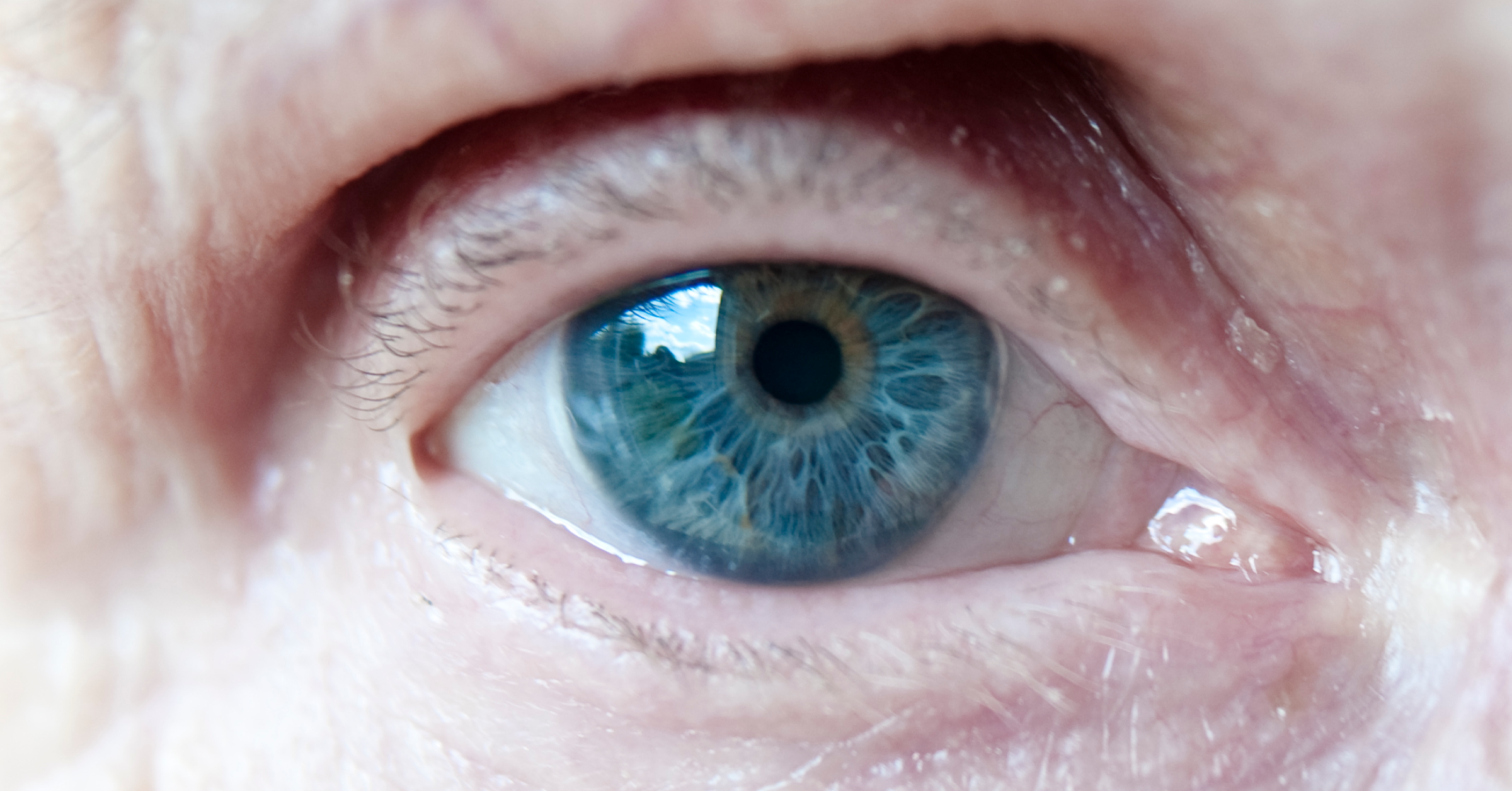 AMD. Blaues Auge eines alten Menschen