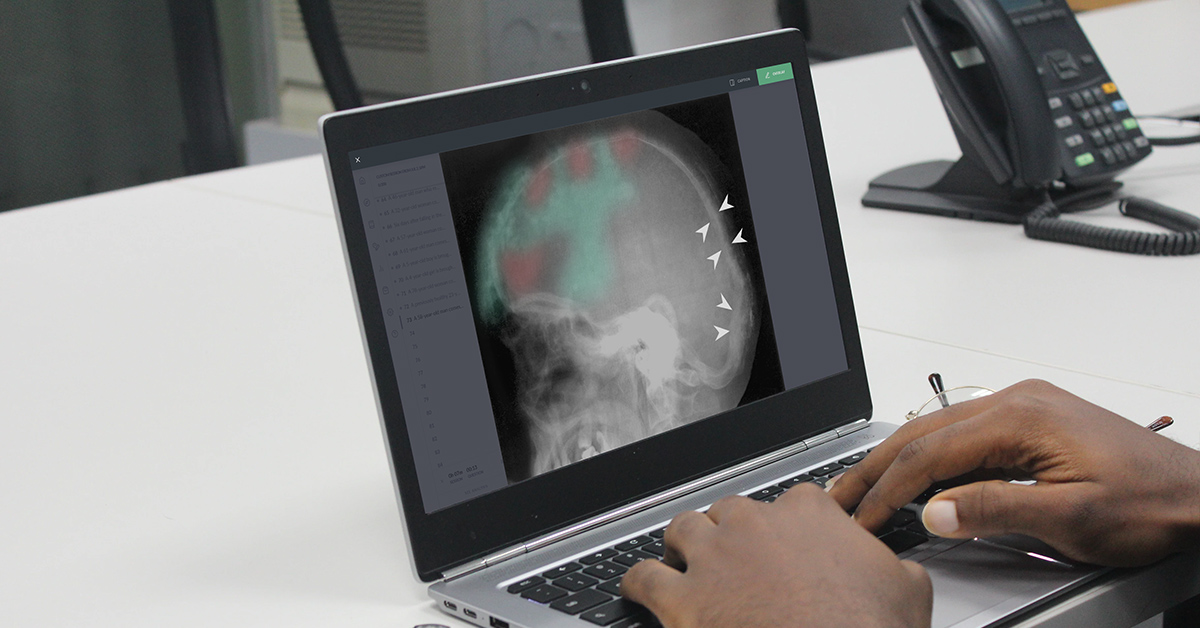 A laptop screen showing a medical overlay image 