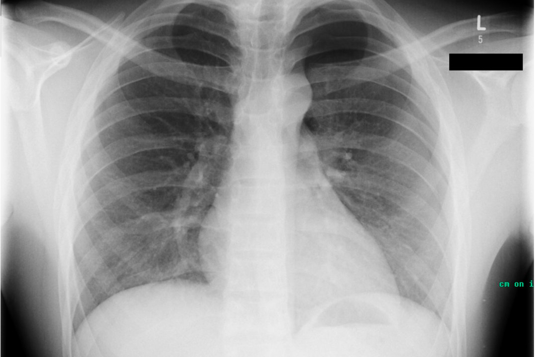 Röntgenbild eines Thorax