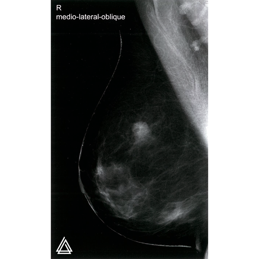   Mammography in breast cancer.  