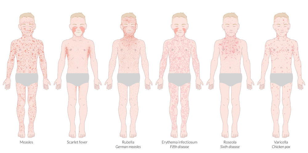   This image represents classic pediatric exanthem diseases, demonstrating the distribution and  morphological characteristics of the exanthem for the differentiation of these diseases, and can be found within the AMBOSS Pediatrics Shelf.  