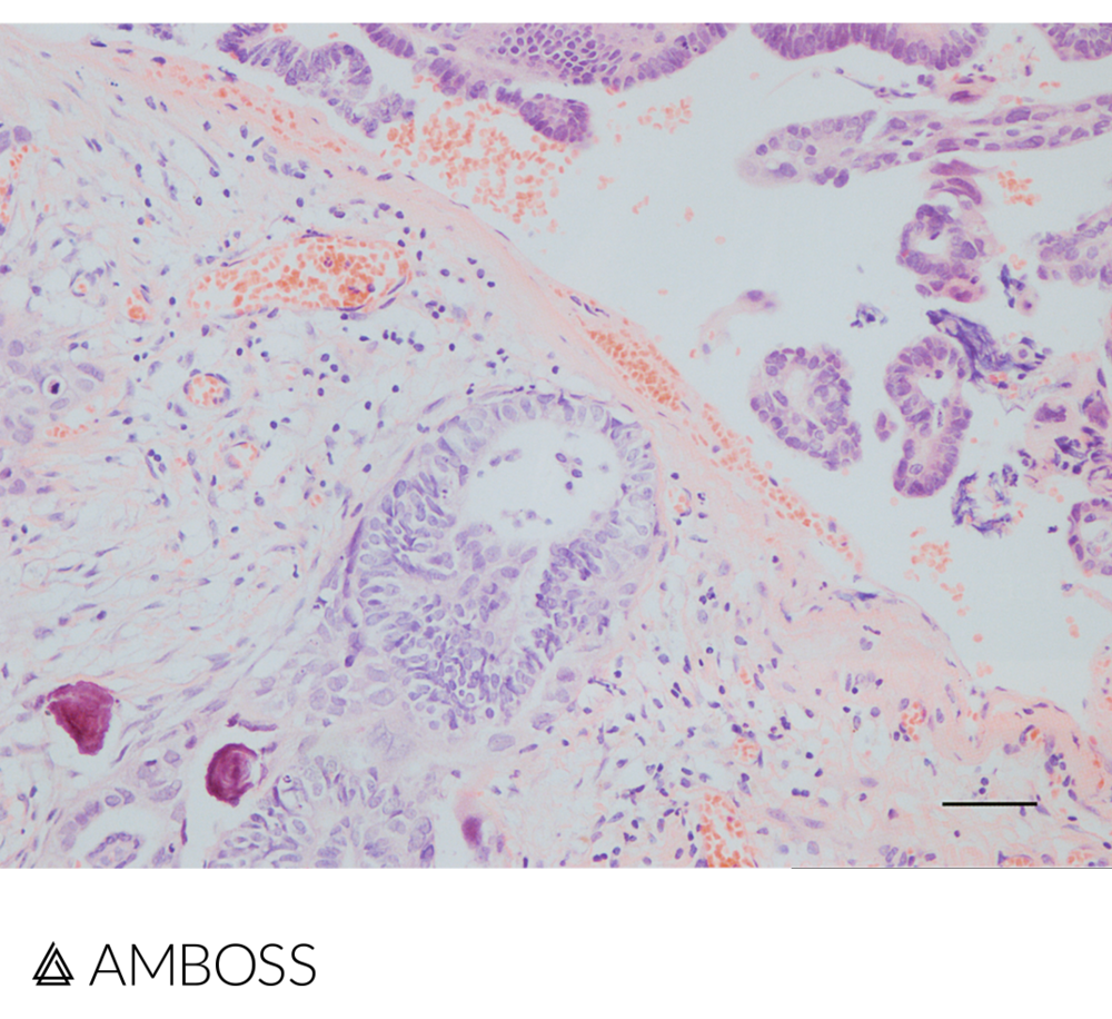   Histopathology slide of the ovary in H&E stain: In addition to papillary tumor cells there are two Psammoma bodies located at the lower edge of the image (highlighted in red). Psammoma bodies are concentric, lamellar calcifications, which are characteristic for serous tumors of the ovary.  