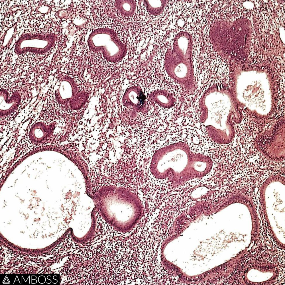   The image shows an H&E stain of endometrial tissue that has been obtained from a fractional curettage.  