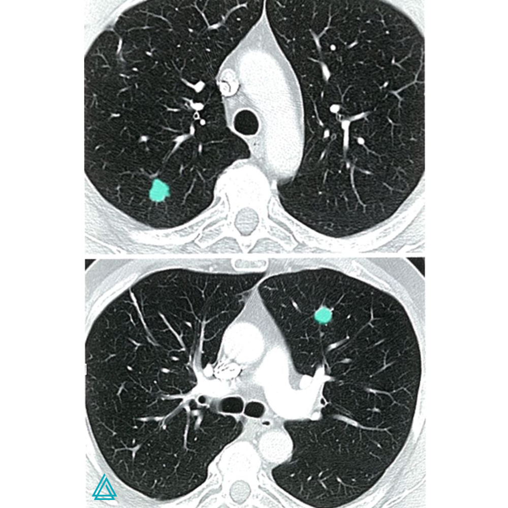   The CT scan of the lung (transverse section) indicates noncalcified lesions located left ventral and right dorsal, which are lung metastases in breast cancer.  