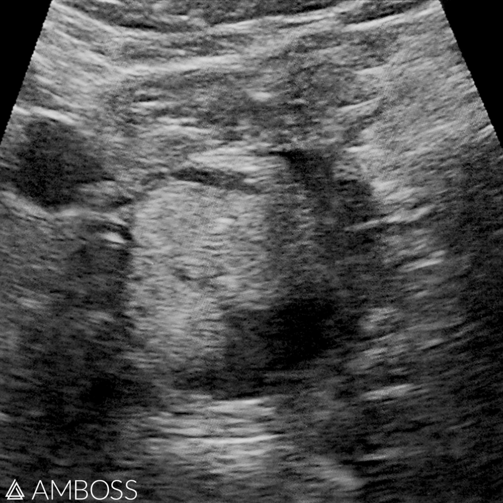   Ultrasound image of a dermoid cyst.  
