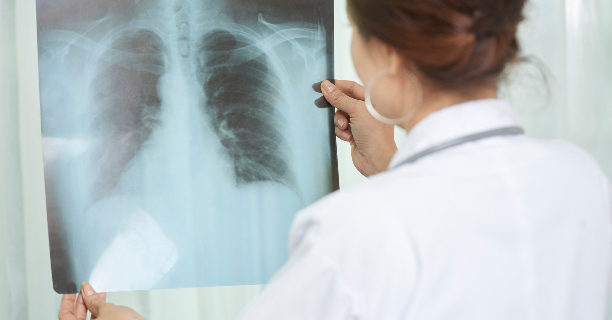 Eine Ärztin wertet ein Röntgenbild des Thorax aus. Tuberkulose im AMBOSS-Blog.