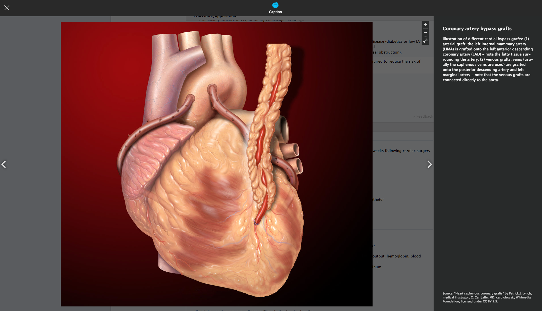 coronary+artery+(2)